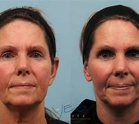 Image result for Facelift and Neck Lift Surgery