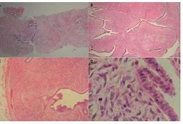 Image result for filoides tumor