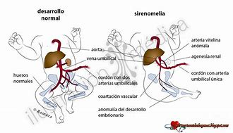 Image result for Sirenomelia