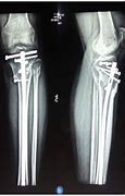 Image result for Lateral Tibial Plateau Fracture