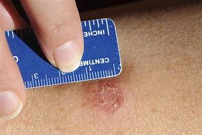 Image result for Fish Eye Skin Infection