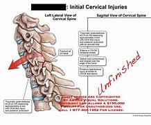 Image result for C5 Spinous Process Fracture