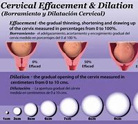 Image result for 2 Cm Dilated