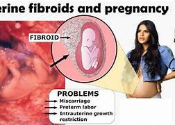 Image result for Fibroids and Pregnancy