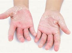 Image result for Dry Peeling Skin On Feet