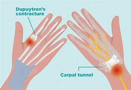 Image result for Pointer Finger Joint Pain