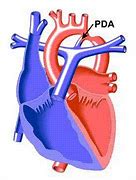 Image result for Coarctation of Aorta