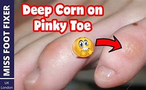 Image result for Pinky Toe Corn