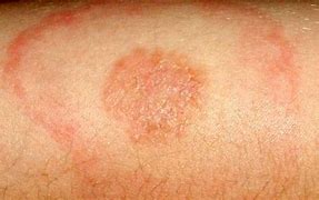 Image result for choroba_z_lyme