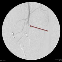 Image result for Left Lower Extremity Angiogram