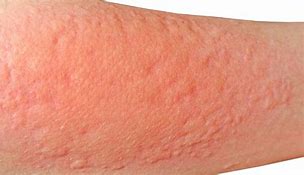Image result for Contact Dermatitis