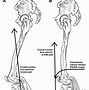 Image result for What Isvascular Gait Dyspraxia