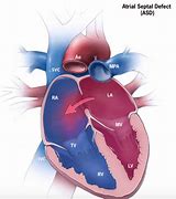 Image result for Atrial Septal Defect