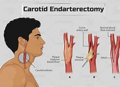 Image result for Carotid Endarterectomy