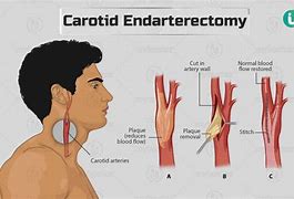 Image result for Carotid Endarterectomy Surgery