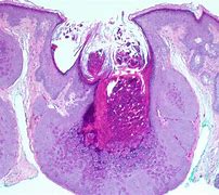 Image result for Molluscum Contagiosum Histology