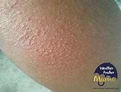 Image result for SunBurn On Dark Skin