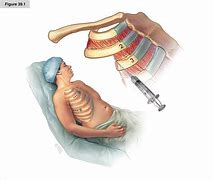Image result for Pneumothorax Chest Tube