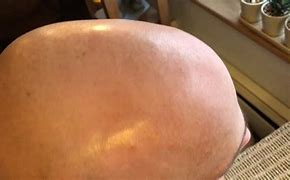 Image result for Laser Hair Removal Scalp