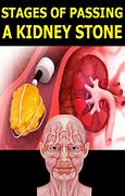 Image result for 5 Cm Kidney Stone