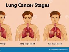 Image result for Lung Tumor Staging