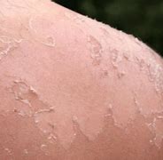 Image result for Itchy Spots After SunBurn