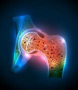 Image result for osteopenia