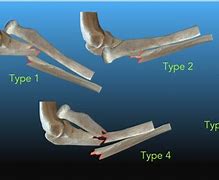 Image result for Closed Reduction Monteggia Fracture