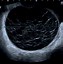 Image result for Ovarian Cyst Right Side Ultrasound