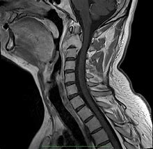 Image result for Cervical Spine MRI T1