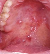 Image result for Kaposi Sarcoma Tongue