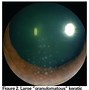 Image result for Ocular Syphilis