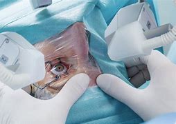 Image result for Lasik Eye Surgery Machine