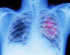 Image result for Cancer X-ray