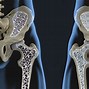 Image result for Osteoporosis Femur