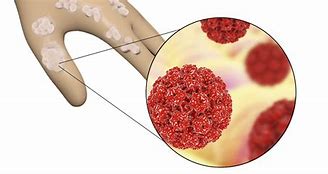 Image result for Human Papilloma
