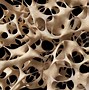 Image result for Osteoporosis Bone Tissue