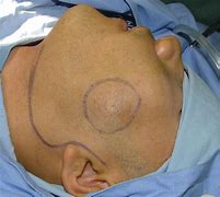 Image result for Parotid Gland Tumor