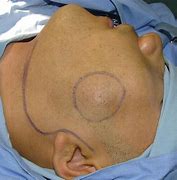 Image result for Parotid Gland Tumor