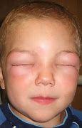 Image result for Allergy Symptom Allergic Reaction