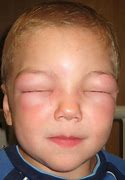 Image result for Allergy Facial Swelling