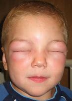 Image result for Allergic Dots