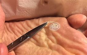 Image result for Foot Plantar Wart Removal