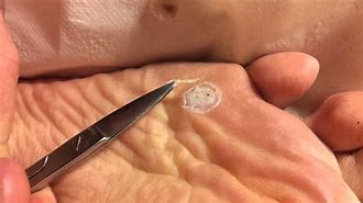 Image result for How to Remove Plantar Warts