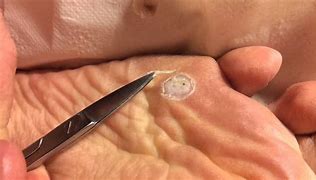 Image result for Removal of Plantar Warts On Foot Bottom