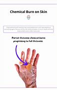 Image result for Baby Lotion Chemical Burn