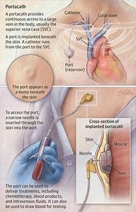 Image result for How Make Central Venous Catheter