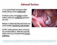 Image result for Torsion of Right Adnexal Cyst
