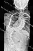 Image result for Neuromuscular Scoliosis