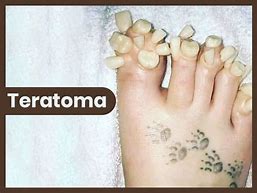 Image result for teratoma